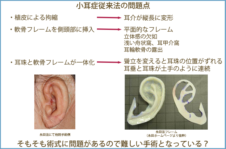 名古屋市で小耳症の治療はゆり形成栄久屋大通クリニックへ